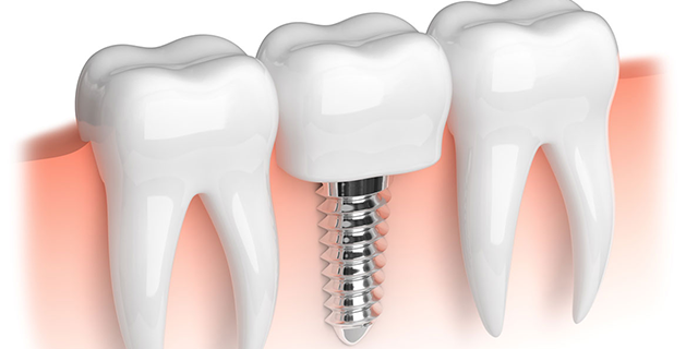 dental implants service in goregaon east