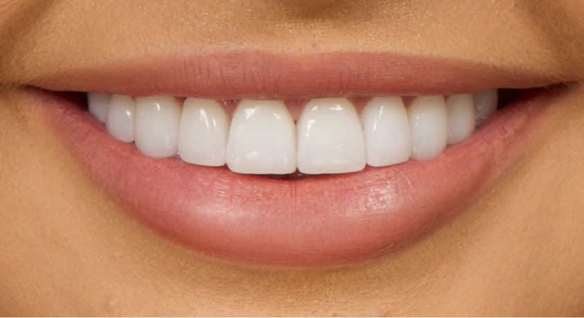 dental veneers treatment