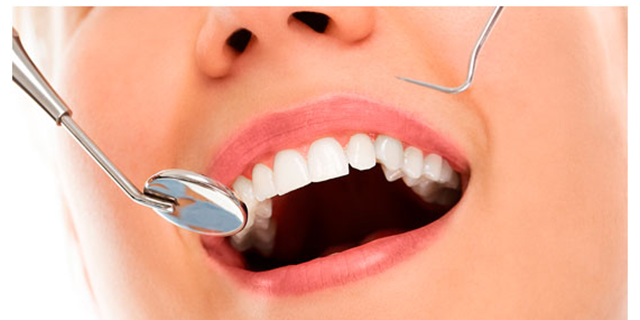 periodontal treatment at Dental Home Goregaon east
