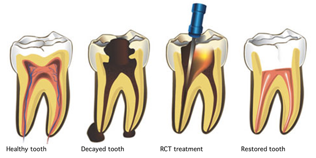 Painless root canal treatment at Dental Home Goregaon