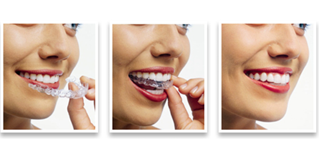 Clear aligners and braces at Dental Home Goregaon