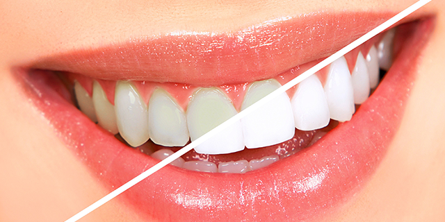 teeth whitening treatment​