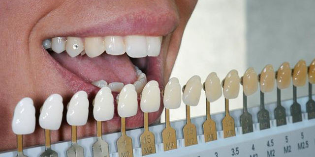 Tooth-colored composite fillings at Dental Home Goregaon