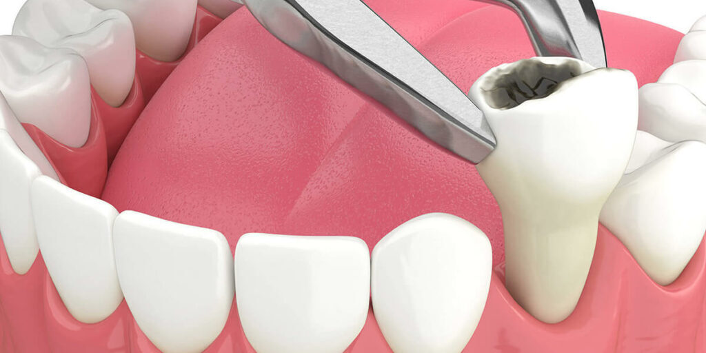tooth extraction services at Dental Home Goregaon east